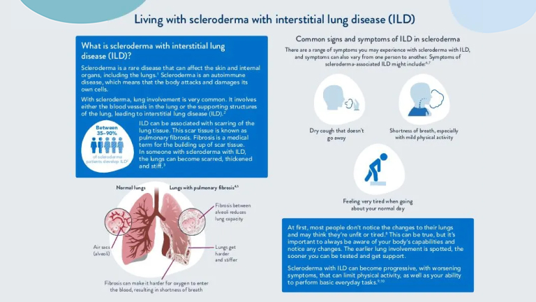 Living with scleroderma-associated interstitial lung disease