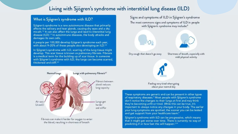 Sjögren’s syndrome with interstitial lung disease
